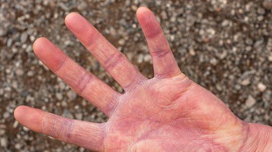 手部湿疹患者如何做好生活保养和调理措施能更好去除?