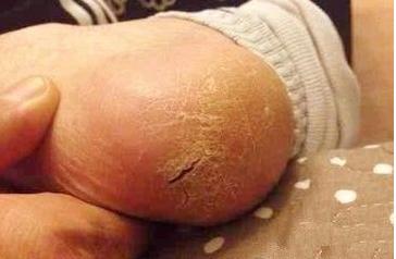 成人湿疹多久能治疗好以及如何有效的促使康复呢?