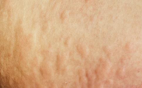 湿疹发病时症状是对称的吗?