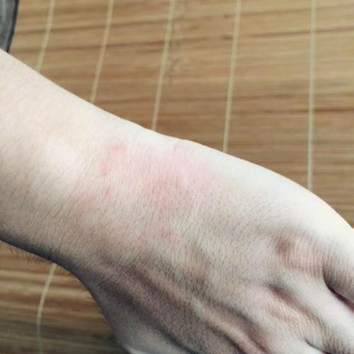 荨麻疹患者应当怎么选择药物方法治疗消除损害呢?