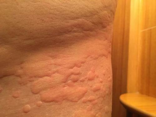 反复的荨麻疹应当如何选择中西医药物方法治愈缓解呢?