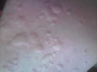 荨麻疹临床上中医是如何辩证的分型和治疗的?