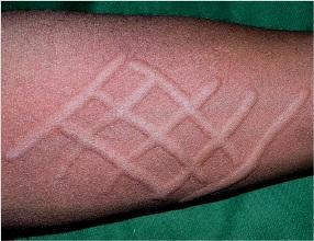 生活当中荨麻疹好发于哪几类人群呢?