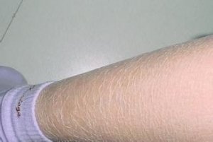 鱼鳞病有哪些变化?