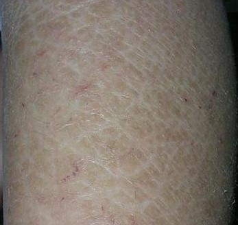 鱼鳞病夏季适合治疗吗