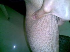 皮肤病的症状图片-鱼鳞病症状