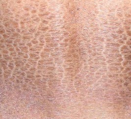 鱼鳞病患者生活当中应当如何做好自我护理呢?