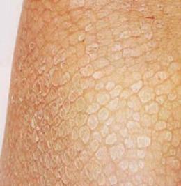 鱼鳞病长期不治疗会对患者造成哪些影响和危害?