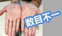 玫瑰糠疹前驱斑数目为1～3个,几周以后躯干与四肢出现数目不等的红色