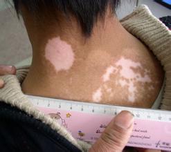 白癜风所带来的危害