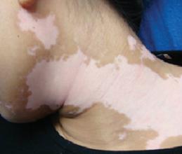 夏季患白癜风应怎么护理