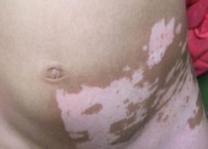小儿白癜风怎么护理好?